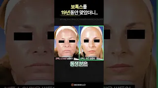 보톡스 10년 맞았더니.. 놀라운 변화가 일어났습니다!! 😲