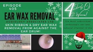 SKIN RIBBON & DRY EAR WAX REMOVAL AGAINST THE EARDRUM - EP405