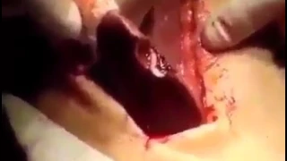 Snakes in stomach of a human