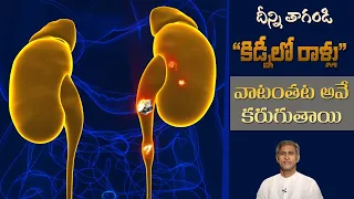 Diet to Prevent Kidney Stones | Drink to Reduce calcium oxalates | Dr.Manthena's Health Tips
