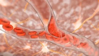 Ischemic Stroke