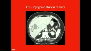 Liver Cysts and Abscesses - CRASH! Medical Review Series