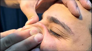 Blackhead and Acne Treatment ASMR Body Massage