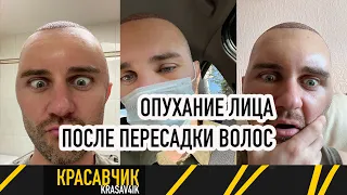 Отёк и опухоль головы после пересадки волос: что делать? / Красавчик