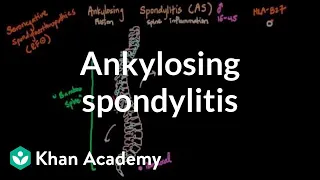 Ankylosing spondylitis | Muscular-skeletal diseases | NCLEX-RN | Khan Academy