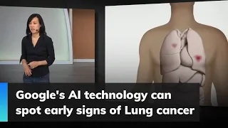 Google's AI technology can spot early signs of Lung cancer