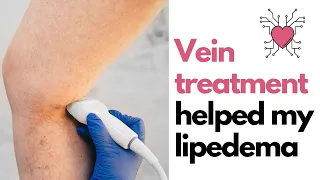 How Vein Treatment Helped My Lipedema and Lymphedema