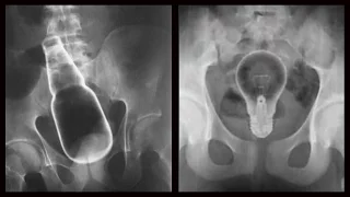 Bizarre X Rays - When People Stick Weird Things Inside Themselves