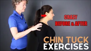 Chin Tuck Exercise - Before and After text neck