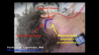 Video of Microvascular Decompression (MVD) for Trigeminal Neuralgia (Brain Surgery)