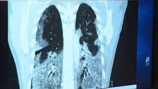 New study researches new target for pneumonia