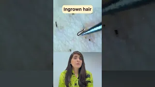 Ingrown hair removal | Ingrown hair | Ingrown hair removal satisfying