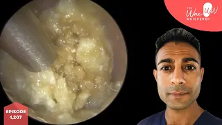 1,207 - White Rock Solid Ear Wax Removal & Keratin Chisel