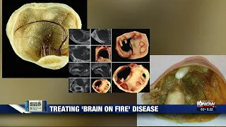 Medical Moment: The signs of 'brain-on-fire' disease