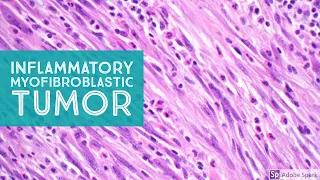IMT: Inflammatory Myofibroblastic Tumor...Explained by a Soft Tissue Pathologist