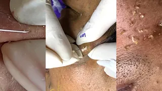 Extreme Blackheads and Whiteheads Extraction ASMR