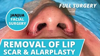 REMOVAL OF LIP SCAR AND ALARPLASTY ON NURSE (LIVE SURGERY) - DR. TANVEER JANJUA - NEW JERSEY