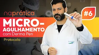 naprática #06 | Protocolo de Microagulhamento com Derma Pen | Passo a passo para profissionais