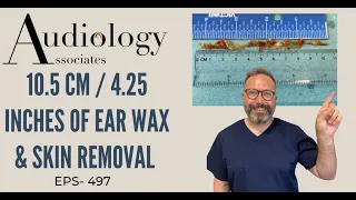 10.5CM/4.25INCH OF EAR WAX & SKIN REMOVAL - EP497