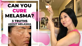 Can You Cure Melasma?  The 3 Truths About Melasma