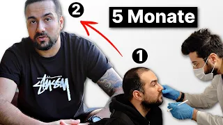 Unglaublich schnell.. 5 Monate & wieder volle Haare | Haartransplantation Erfahrung