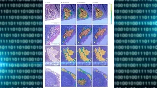 Deep Learning Algorithms for Detection of Lymph Node Metastases From Breast Cancer