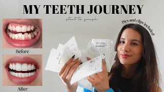 MY TEETH JOURNEY | Invisalign, Composite Bonding, Whitening | Answering All Your Questions
