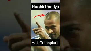 Hardik Pandya hair transplant result