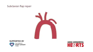 Coarctation of the Aorta: treatment