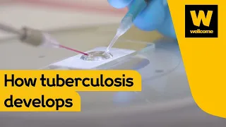 Understanding how tuberculosis develops | Wellcome