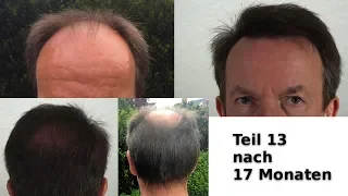 Haartransplantation in Istanbul (13) Nach 17 Monaten