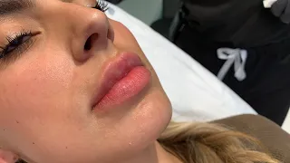 GET THOSE JUICY RUSSIAN LIPS 👄WITH NO DOWNTIME FILLER INJECTIONS | Hollywood, CA | Dr. Jason Emer