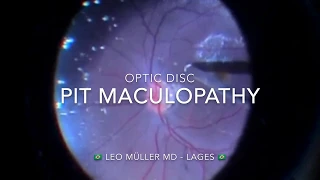 Optic disc pit maculopathy - Author: Leo Müller MD