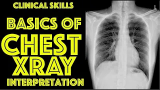 How To Read A Chest X-ray For Beginners - Dr. Gill