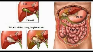 Tư vấn sức khỏe : Sỏi túi mật | Trực tiếp ngày 03/07/2020 trên Radio97