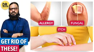 Get Rid of Itchy Skin, Skin Allergy & Fungal Infection! (Urdu/Hindi) Kharish | Dr. Ibrahim