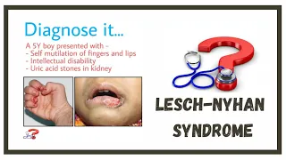 A child with self mutilation behaviour  - Lesch Nyhan Syndrome