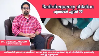 How to remove skin tags, warts (പാലുണ്ണി ,അരിമ്പാറ)| Radiofrequency ablation Malayalam | @DermaVue