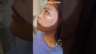 Scarless Facelift by Dr.TAS