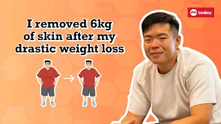 I removed 6kg of skin after my drastic weight loss