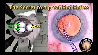 How to optimize the red reflex during cataract surgery