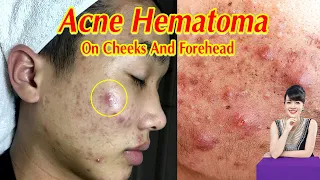 Điều trị mụn hiệu quả TPHCM | Hiền Vân Spa | Acne Treatment | Acne Removal | 621