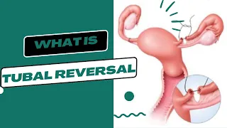 WHAT IS TUBAL REVERSAL?