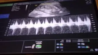 Baby boy's heartbeat at 16 weeks