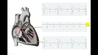 EKG BRADYARRHYTHMIA