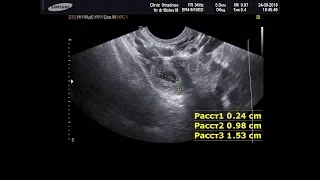 Внематочная беременность на УЗИ органов малого таза (24-9-18)