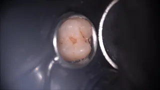 препаровка  щелевидной поддесневой полости на 27 зубе