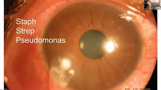 Lecture: Corneal Disease and Dystrophy Management