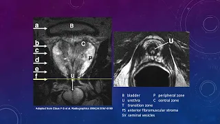 Introduction to PI-RADS