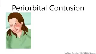 Periorbital contusion no CT